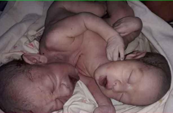 স্বরূপকাঠিতে জোড়া লাগানো জমজ শিশুর জন্ম! 